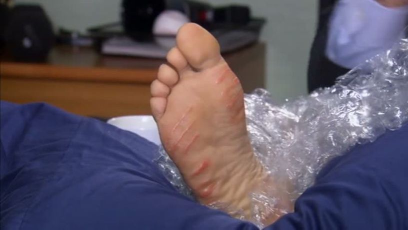 A burned foot packed in bubble wrap sitting on a cushion.